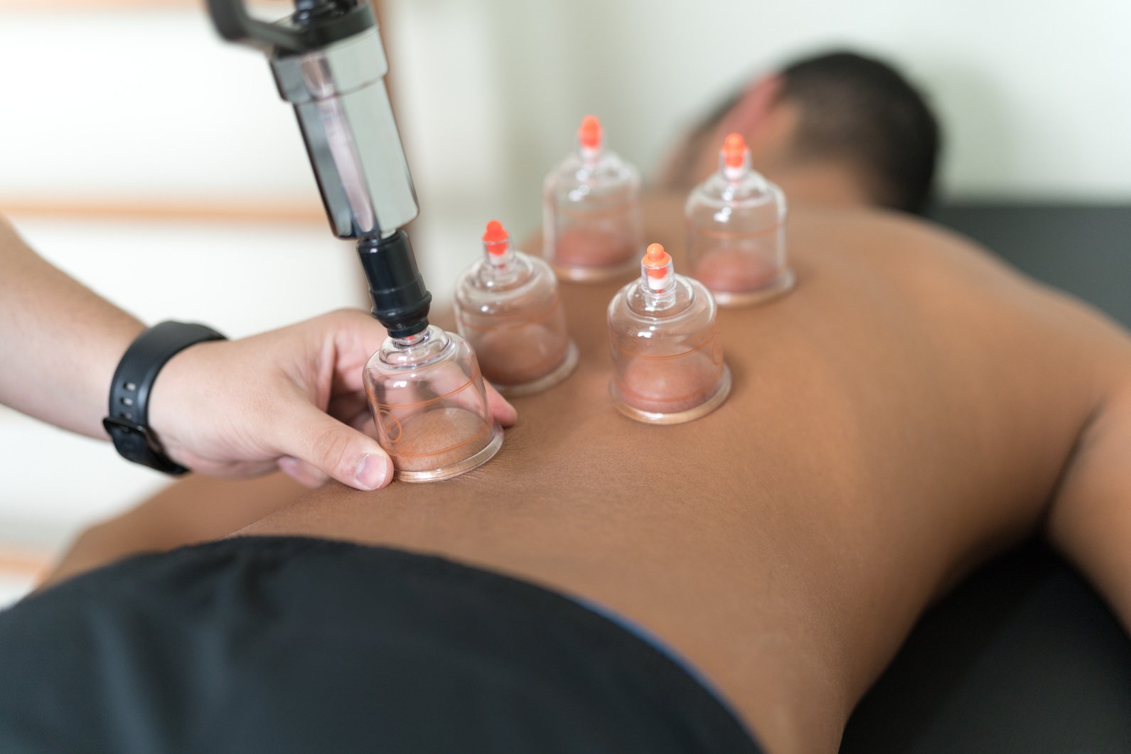 Applying cupping therapy in traditional chinese medicine on man back
